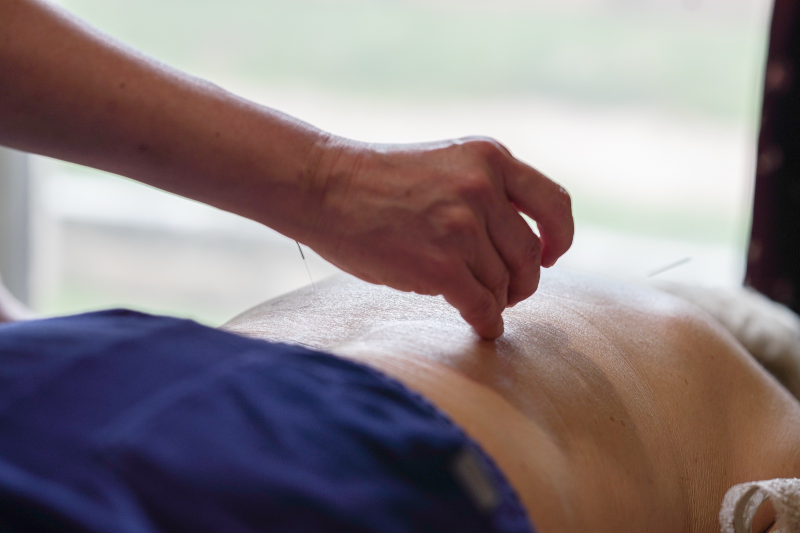 Dr. Hedy Chen placing a fine acupuncture needle on a patient's back